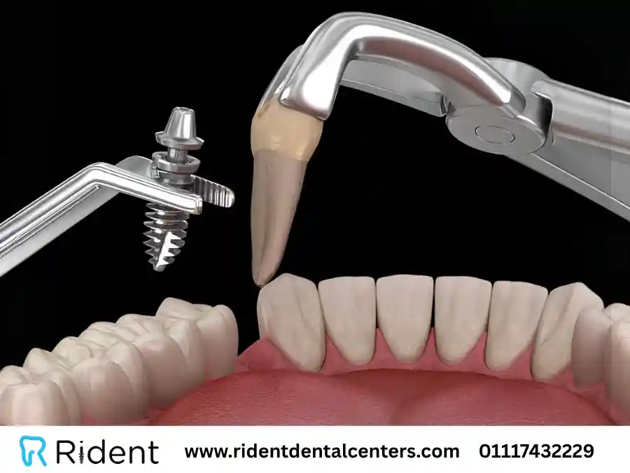 التحميل الفوري على التركيبات